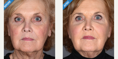 Dermal Fillers before and after photo