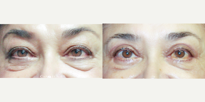 Eyelid Surgery before and after photo