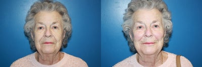 Radiesse before and after photo