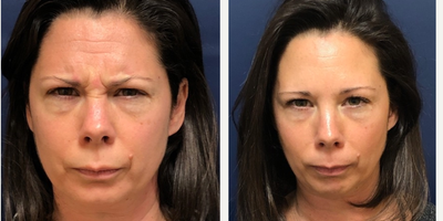 Botox before and after photo