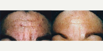 Chemical Peel before and after photo