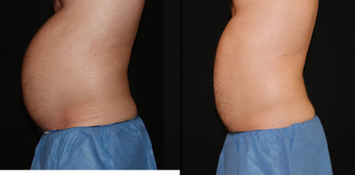 CoolSculpting before and after photo