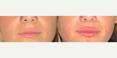 Dermal Fillers before and after photo