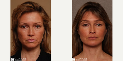 Facial Fat Transfer before and after photo