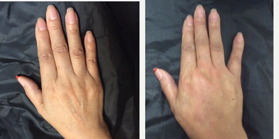 Radiesse before and after photo