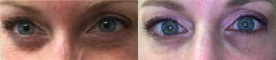 Restylane Silk before and after photo