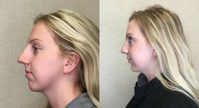 Restylane before and after photo