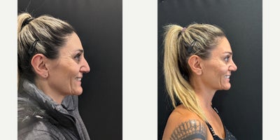 Rhinoplasty before and after photo