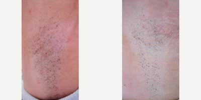 Skin Lightening before and after photo
