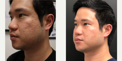Vampire Facelift before and after photo