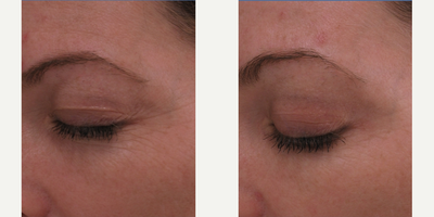 Botox before and after photo