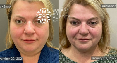 FaceTite before and after photo