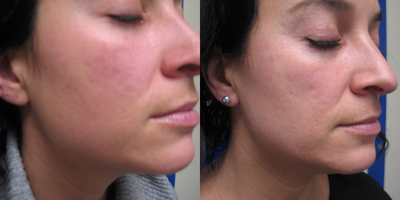 IPL before and after photo