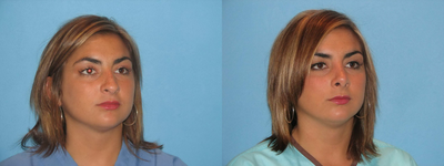 Rhinoplasty before and after photo