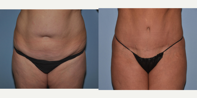 Tummy Tuck before and after photo