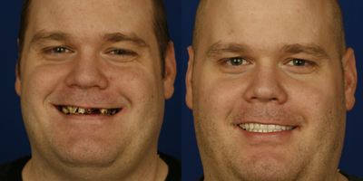 All-on-4 Dental Implants before and after photo