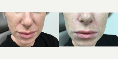 Dermal Fillers before and after photo
