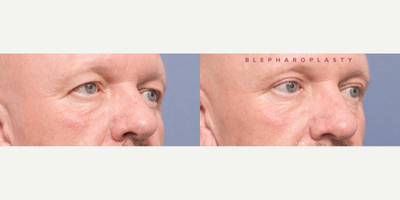 Eyelid Surgery before and after photo