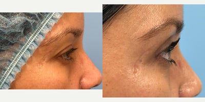 Eyelid Surgery before and after photo