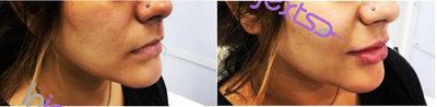 Lip Fillers before and after photo