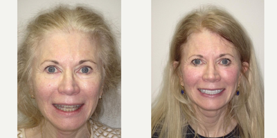 Porcelain Veneers before and after photo