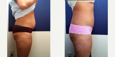 Smart Lipo before and after photo