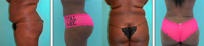 Brazilian Butt Lift before and after photo