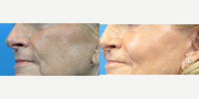 Cheek Augmentation before and after photo