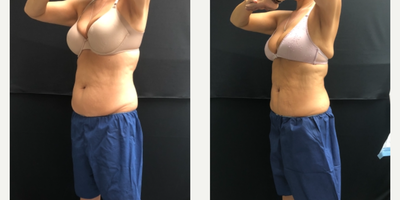 CoolSculpting before and after photo