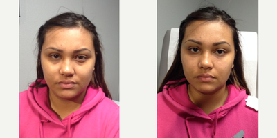 Dermal Fillers before and after photo