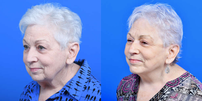 Facelift before and after photo