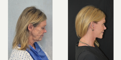 Facial Fat Transfer before and after photo