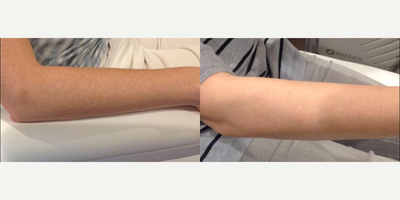 IPL before and after photo