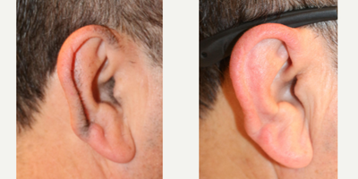 Laser Hair Removal before and after photo