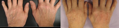 Radiesse before and after photo