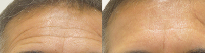 Botox before and after photo