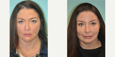 Eyelid Surgery before and after photo
