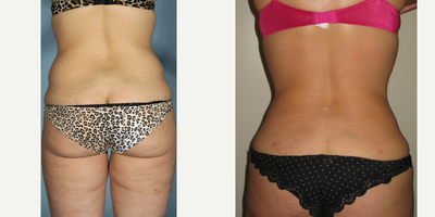 Liposuction before and after photo