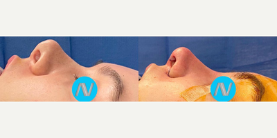 Revision Rhinoplasty before and after photo