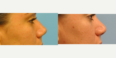 Rhinoplasty before and after photo