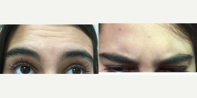 Botox before and after photo
