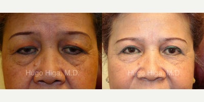 Eyelid Surgery before and after photo