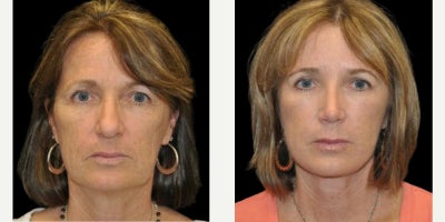 Facelift before and after photo