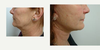 before and after image