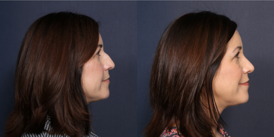 Rhinoplasty before and after photo