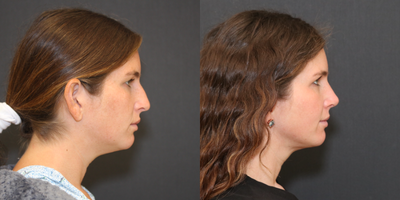 Rhinoplasty before and after photo