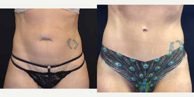 Tummy Tuck before and after photo