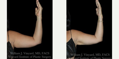 BodyTite before and after photo