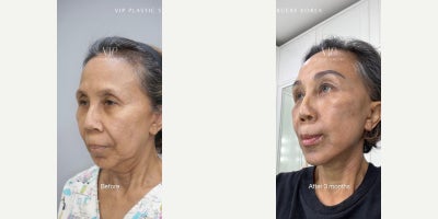 Facelift before and after photo