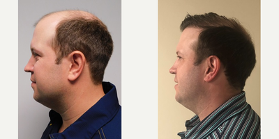 Hair Loss Treatment before and after photo